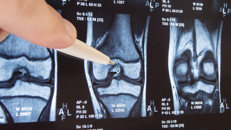 Röntgenbild: Der Krankheitsverlauf einer Kniearthrose lässt sich in vier Stadien unterteilen. Diese werden mittels Röntgenstrahlen untersucht.