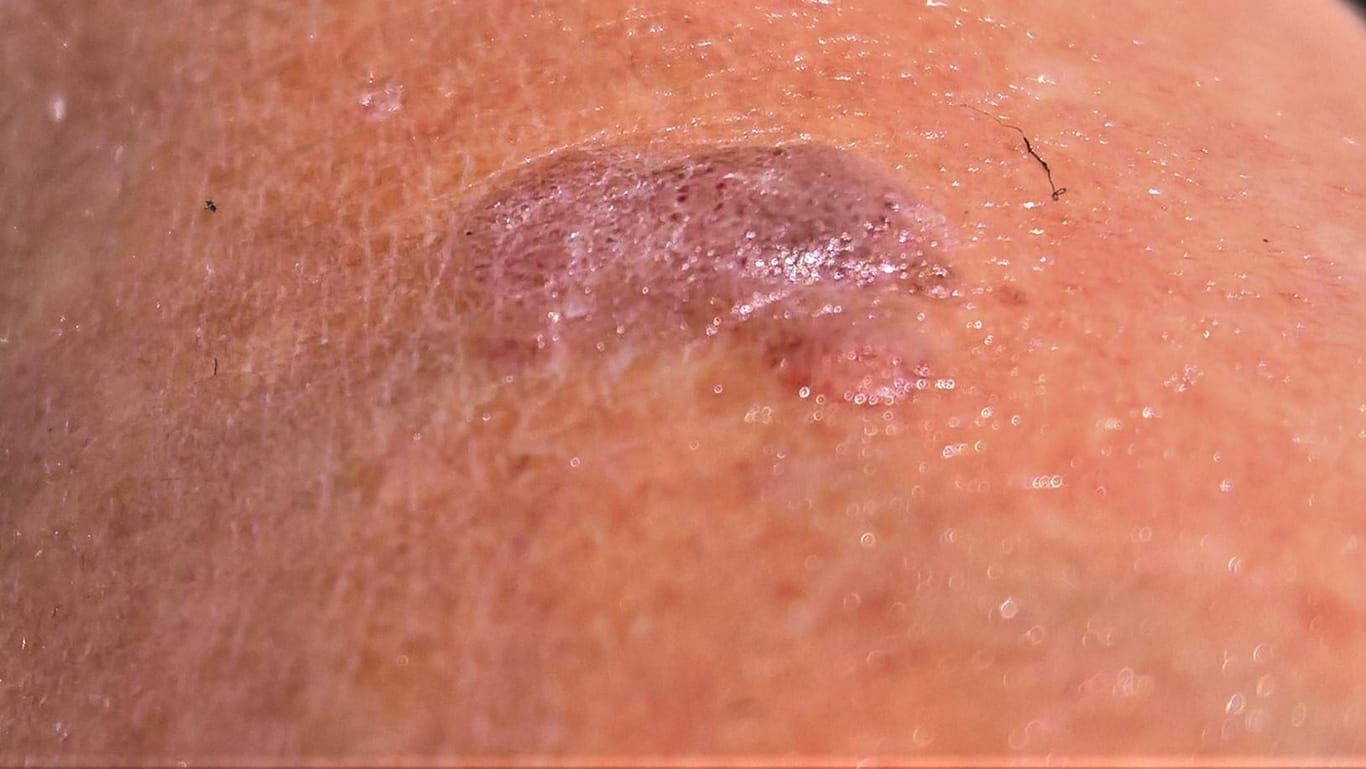 Hautmal auf Arm: Hautkrebs ist ein Oberbegriff für sämtliche bösartigen Veränderungen der Haut. In der Umgangssprache wird er oft gleichgesetzt mit dem malignen Melanom.