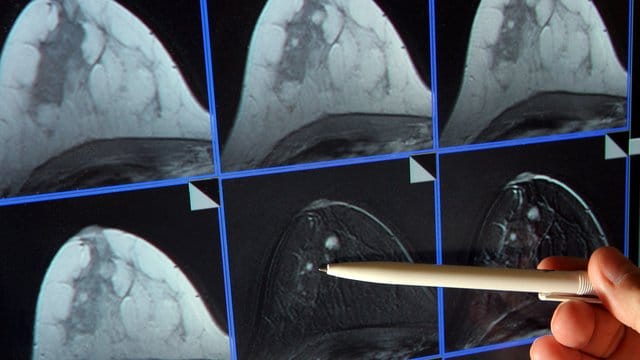 Brustkrebs-Patientinnen können zukünftig eine weitere Kassenleistung erhalten. Brustkrebs-Patientinnen können zukünftig eine weitere Kassenleistung erhalten.