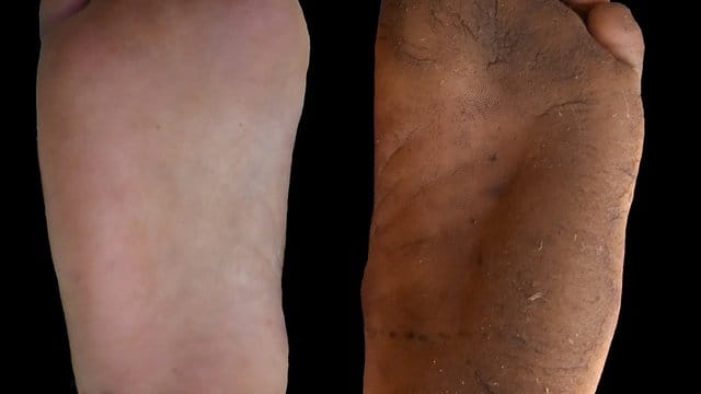 Die Füße eines Mannes mit und ohne Hornhaut. Die Füße eines Mannes mit und ohne Hornhaut.