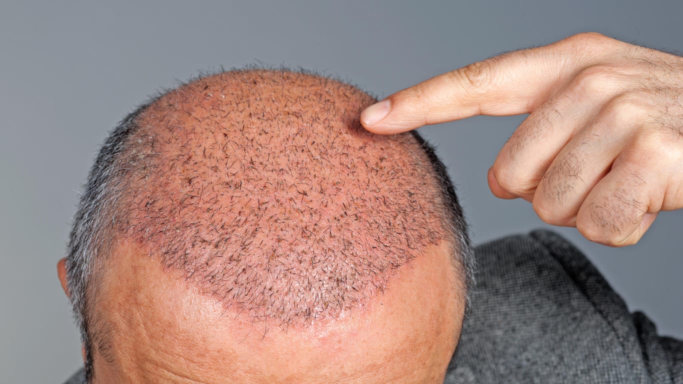 Genetisch bedingter Haarausfall ist vor allem bei Männern weit verbreitet. Eine Haartransplantation hilft, kahle Stellen und Geheimratsecken wieder zu füllen.