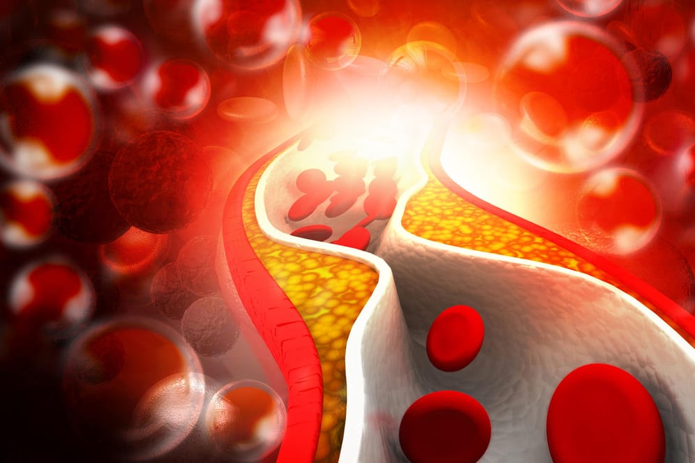 Verengte Gefäße: Bei der Arteriosklerose kann das sauerstoffreiche Blut nicht mehr gut transportiert werden.