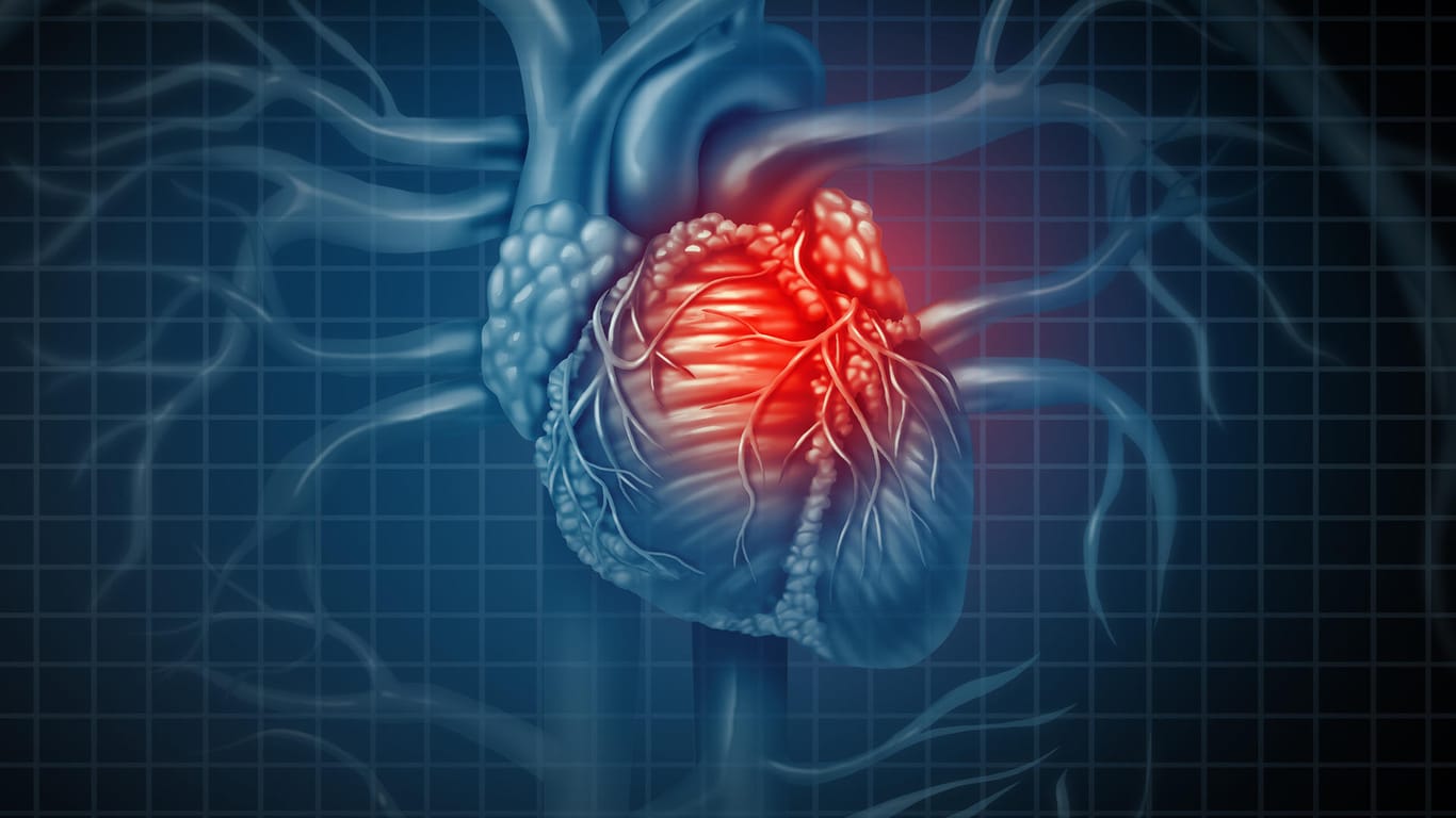 Herzinfarkt: Finnische Forscher entdeckten, dass ein Großteil der untersuchten Fälle an plötzlichem Herzversagen aufgrund einer koronaren Herzkrankheit starben – ohne von der Erkrankung zu wissen.