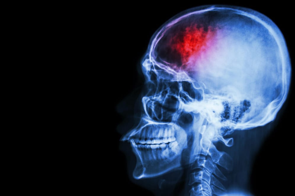 Seitliche Röntgenaufnahme eines menschlichen Kopfes: Neue medizinische Untersuchungsergebnisse basieren auf Daten von 190.000 Patienten, die unter anderem wegen Schlaganfällen behandelt worden sind.