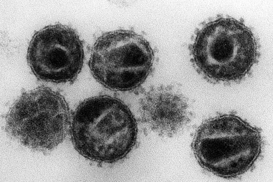 Das HI-Virus befällt und zerstört bestimmte Zellen der Immunabwehr und macht Infizierte anfällig für Krankheiten.