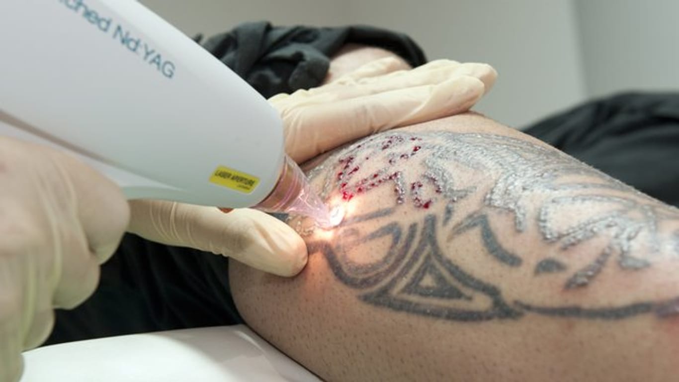 Eine Tattoo-Entfernung ist nicht unbedenklich - wer seine Tätowierung loswerden will, sollte die Laserbehandlung von Fachleuten durchführen lassen.