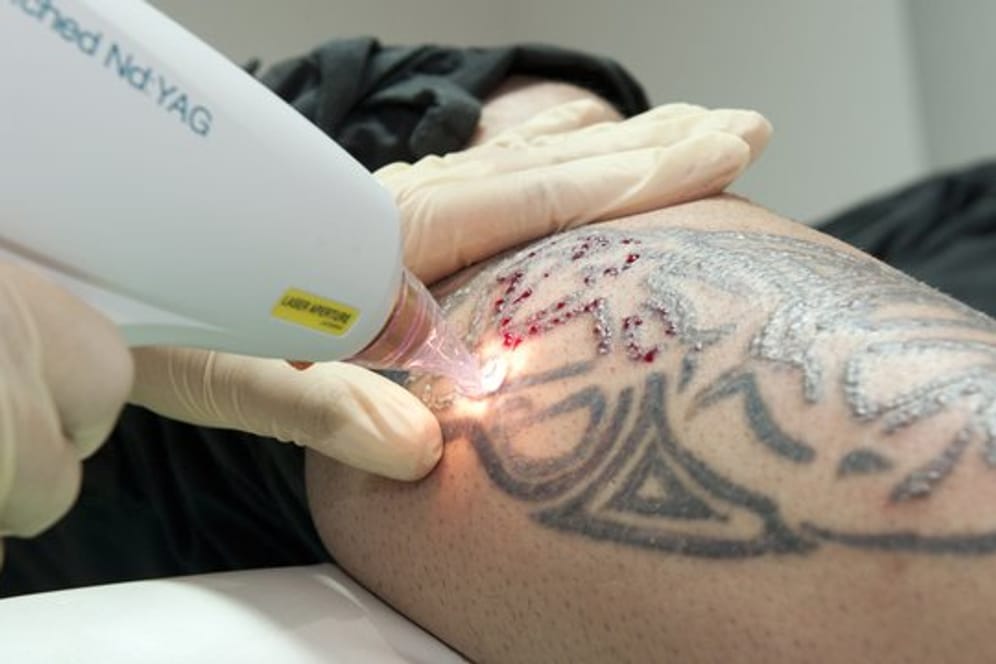 Eine Tattoo-Entfernung ist nicht unbedenklich - wer seine Tätowierung loswerden will, sollte die Laserbehandlung von Fachleuten durchführen lassen.