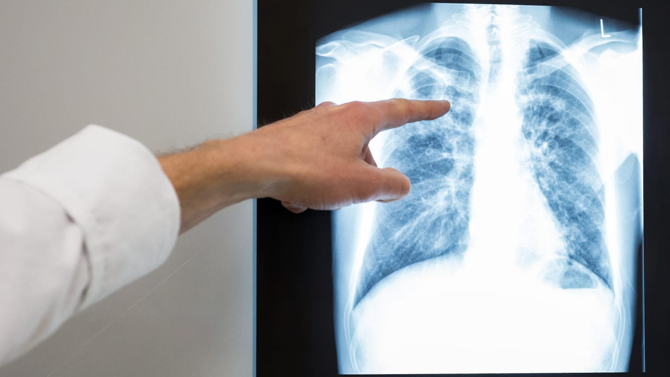 Röntgenbild einer Lunge: Eine Übertragung der Krankheit Tuberkulose findet über Tröpfchen in der Luft statt.
