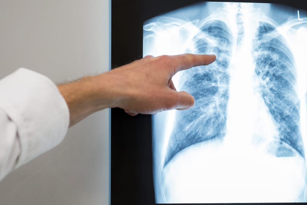 Röntgenbild einer Lunge: Eine Übertragung der Krankheit Tuberkulose findet über Tröpfchen in der Luft statt.