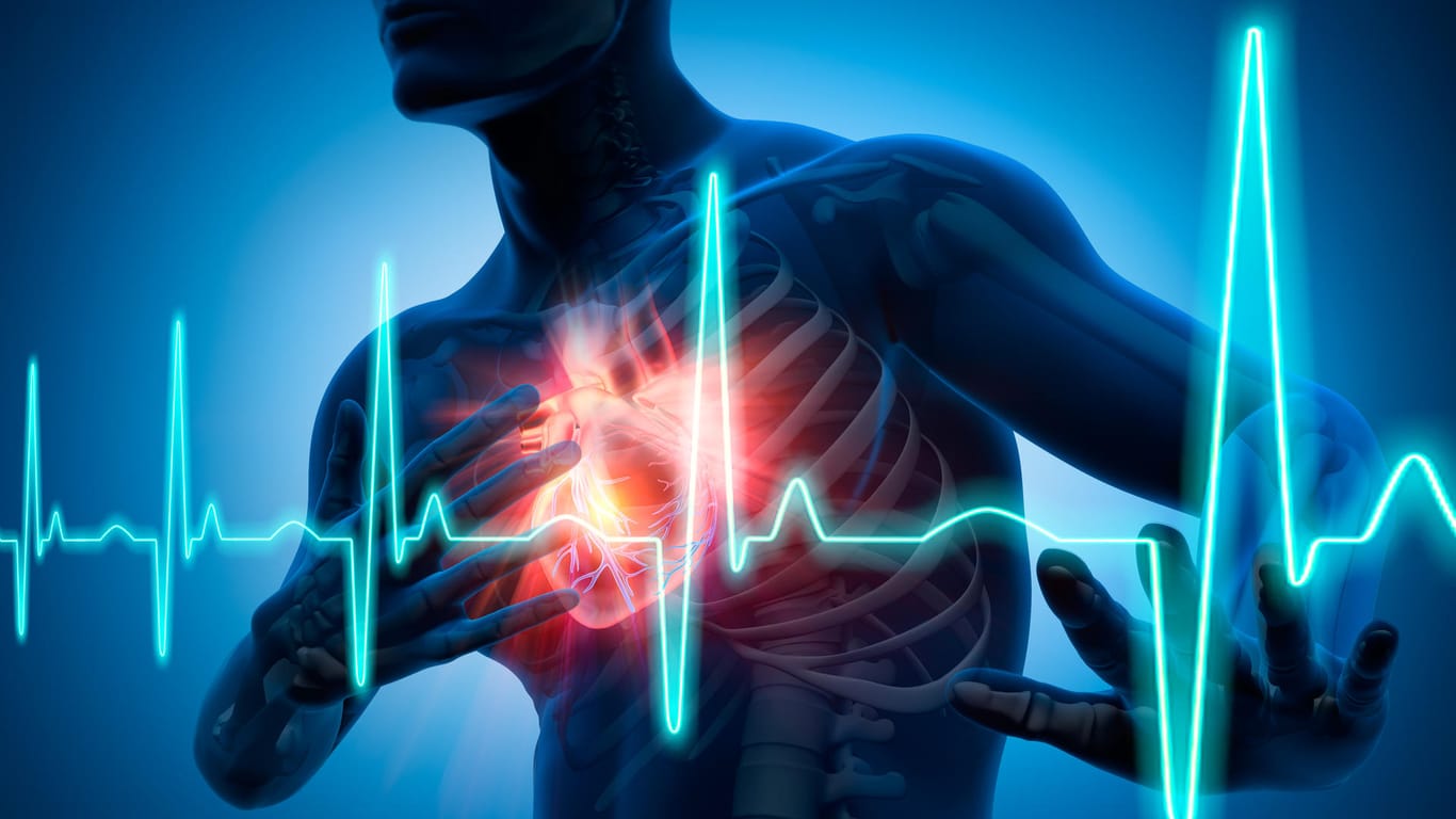 Herzinfarkt: Der Herzinfarkt (Myokardinfarkt) ist der bekannteste Infarkt. Jedes Jahr erleiden fast 280.000 Menschen in Deutschland den Infarkt im Herzen, häufig mit tödlichem Ausgang.