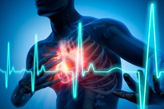 Herzinfarkt: Der Herzinfarkt (Myokardinfarkt) ist der bekannteste Infarkt. Jedes Jahr erleiden fast 280.000 Menschen in Deutschland den Infarkt im Herzen, häufig mit tödlichem Ausgang.