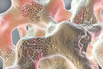 3D-Illustration von Knochen, die mit Osteoporose befallen sind: Osteoporose entwickelt sich unbemerkt. Der Knochenschwund verursacht zu Beginn weder Schmerzen noch andere Beschwerden.