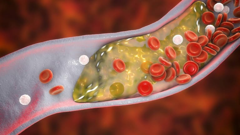 Cholesterin in einer Arterie: Hohe Cholesterinwerte begünstigen die Entstehung von Ablagerungen in den Gefäßen, die zu einem Schlaganfall führen können.