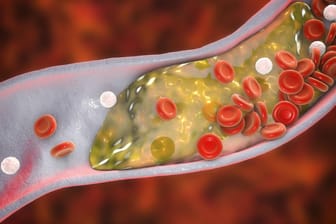 Cholesterin in einer Arterie: Hohe Cholesterinwerte begünstigen die Entstehung von Ablagerungen in den Gefäßen, die zu einem Schlaganfall führen können.