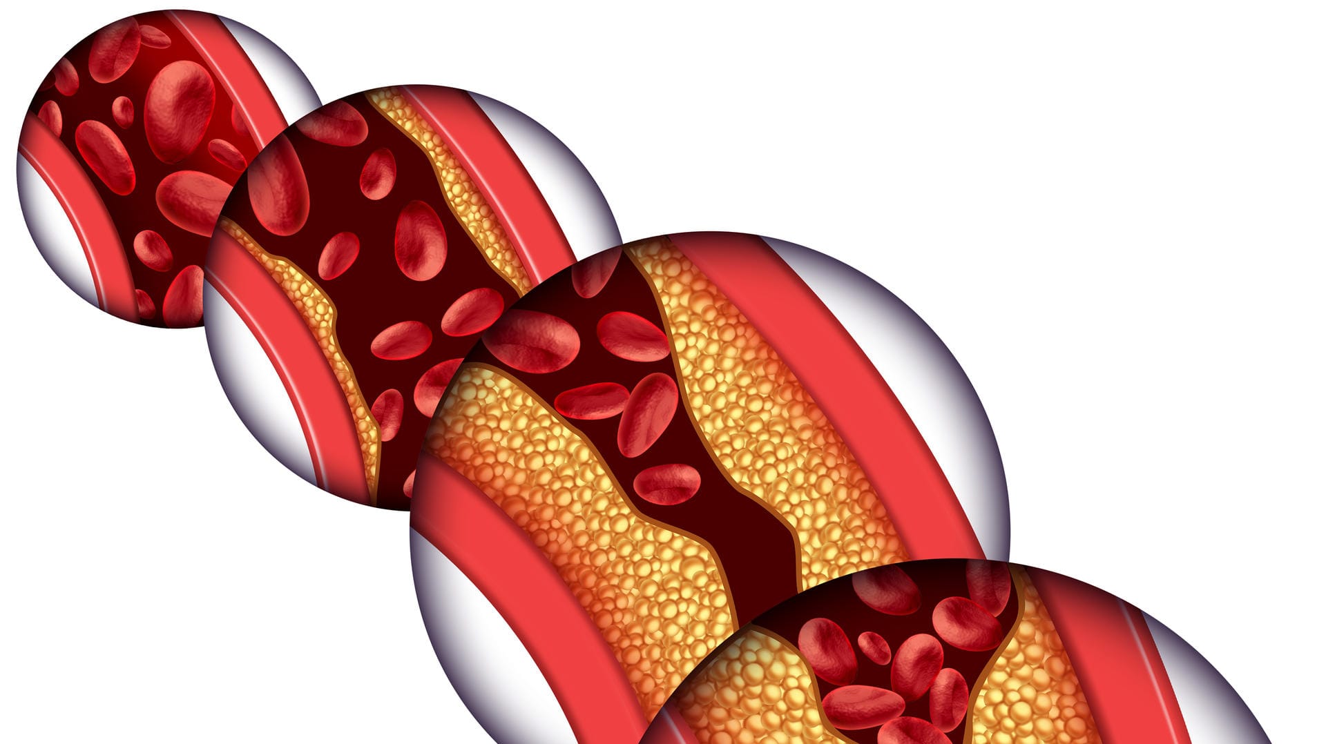 Eine Angina Pectoris ist immer ein Symptom dafür, dass es in der Herzkranzgefäßen zu Verengungen aufgrund von Ablagerungen gekommen ist. Wenn dieser Prozess fortschreitet, droht ein Herzinfarkt.