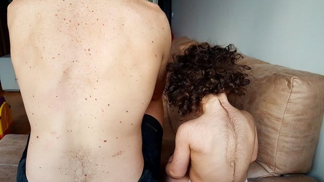 Ein Mädchen mit dem vom sogenannten "Werwolf-Syndrom" (r. Ein Mädchen mit dem vom sogenannten "Werwolf-Syndrom" (r.