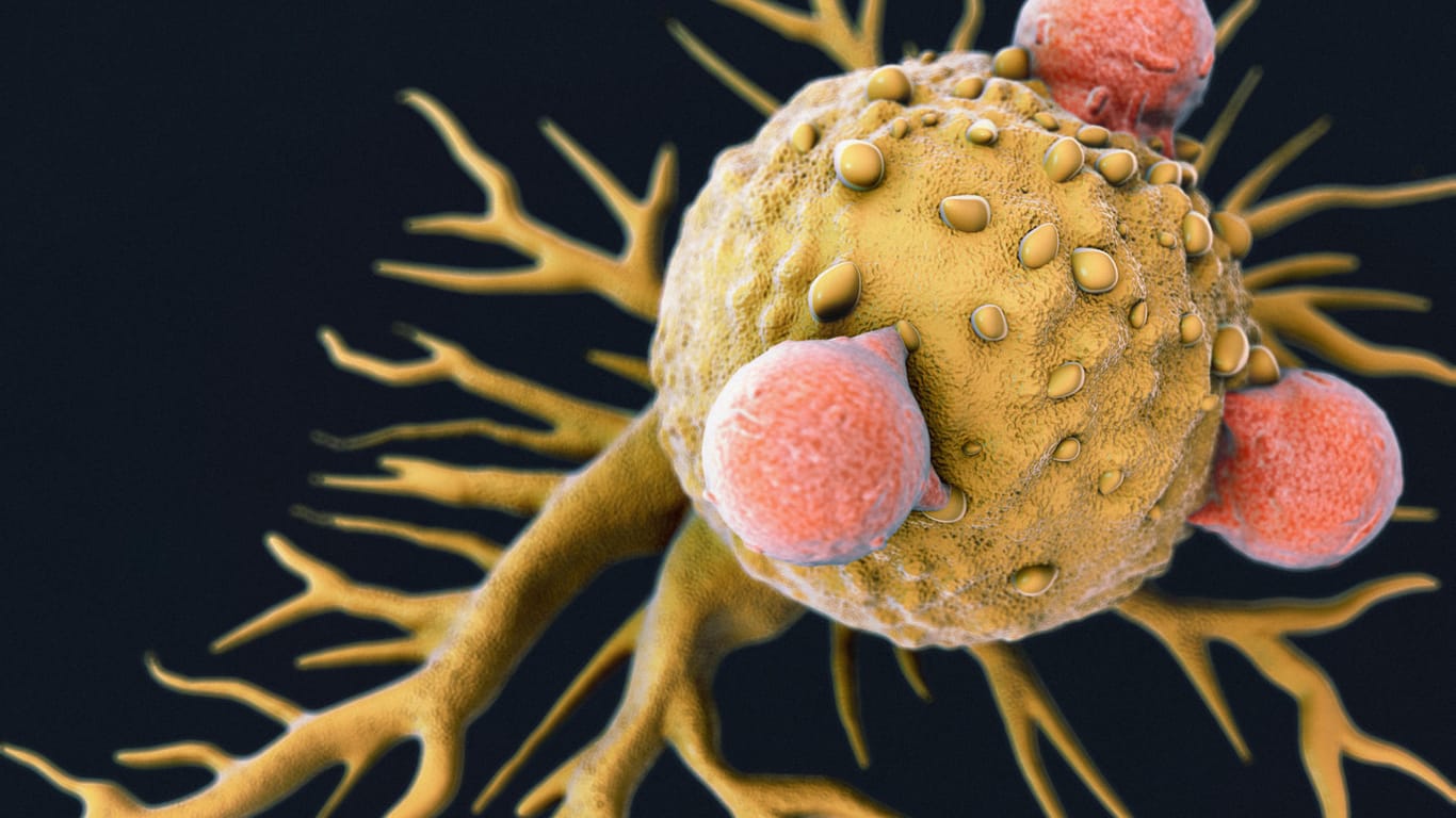 Lymphdrüsenkrebs: Die bösartigen Zellen führen in einigen Ländern häufiger zum Tod als Erkrankungen des Herz-Kreislaufsystems. (Symbolbild)