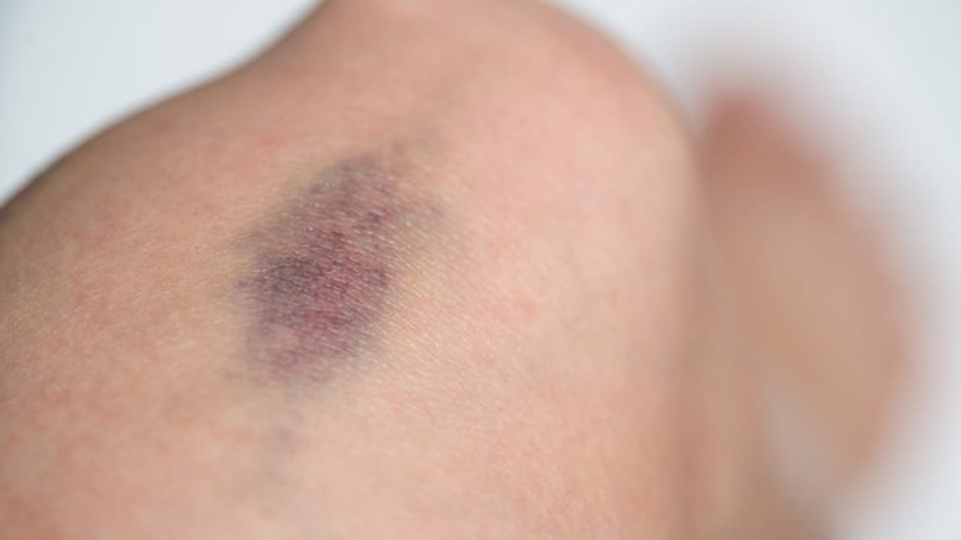 Wenn man öfter nach eher harmlosen Zusammenstößen blaue Flecken bekommt, kann das ein Anzeichen für eine Blutgerinnungsstörung sein.