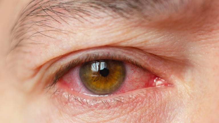 Entzündetes Auge: Dahinter kann die Erkrankung Uveitis stecken. Sie betrifft verschiedene Bereiche des inneren Auges.