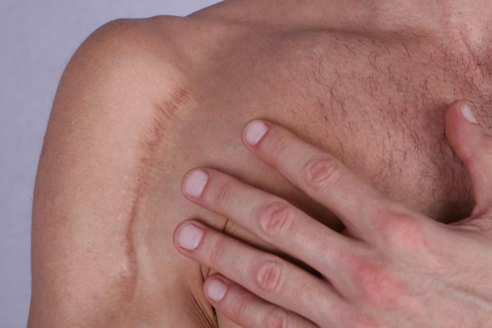 Narbe auf der Schulter: Wird die Haut durch einen Unfall oder eine Operation verletzt, können Narben zurückbleiben.