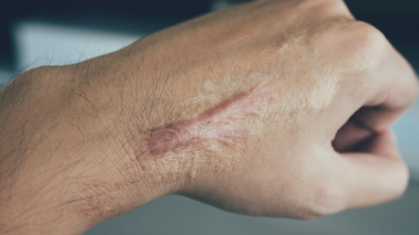 Narbe auf dem Handrücken: Wenn eine Narbe wuchert, also zusätzliches Gewebe bildet, sprechen Mediziner von einer Keloidnarbe.