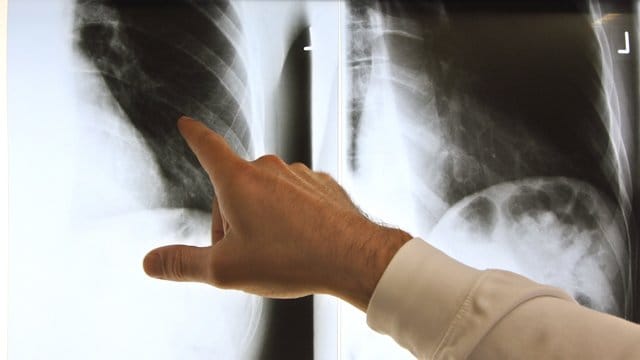 Patienten können bei rechtzeitiger Behandlung heute mit weniger Beschwerden leben als noch vor einigen Jahren. Patienten können bei rechtzeitiger Behandlung heute mit weniger Beschwerden leben als noch vor einigen Jahren.