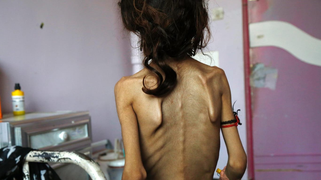 Hungerleidendes Mädchen im Jemen: Die Hungerkrise in dem Land hält seit Jahren an. Für die Entwicklung der Kinder hat sie besonders weitreichende Folgen.