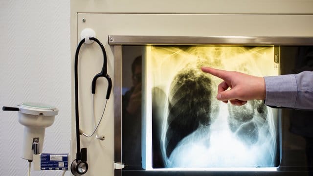 WHO braucht Geld für Tuberkulose-Prävention bei gefährdeten Kindern. WHO braucht Geld für Tuberkulose-Prävention bei gefährdeten Kindern.