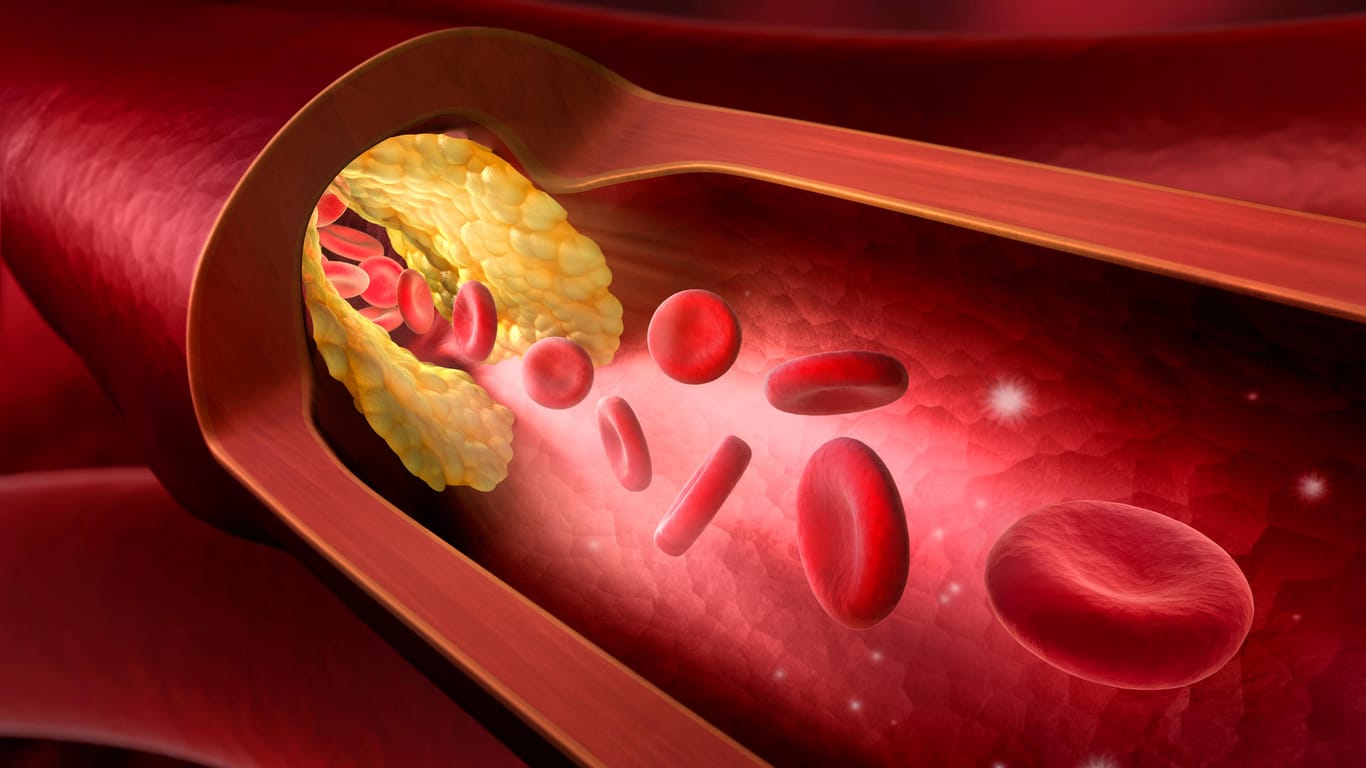 Verkalkte Arterie: Arteriosklerose ist für den überwiegenden Teil der Herz-Kreislauf-Erkrankungen verantwortlich.