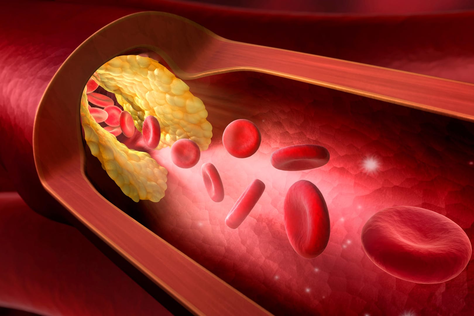 Verkalkte Arterie: Arteriosklerose ist für den überwiegenden Teil der Herz-Kreislauf-Erkrankungen verantwortlich.