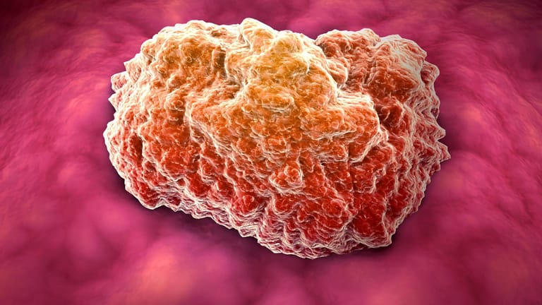 Tumor: Experten haben eine "deutliche Korrelation" zwischen Übergewicht und Krebsrisiko belegt.