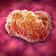 Tumor: Experten haben eine "deutliche Korrelation" zwischen Übergewicht und Krebsrisiko belegt.