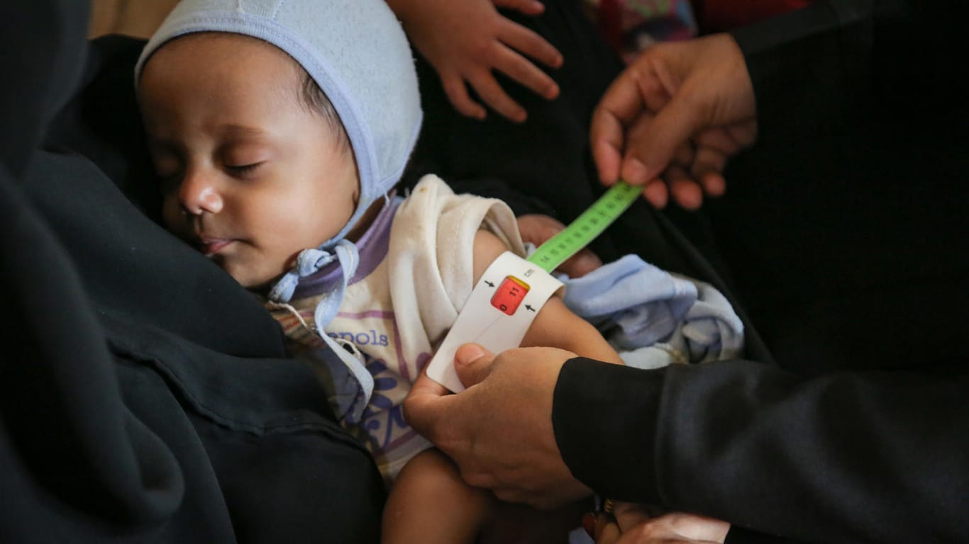 Jemen: Salim ist sieben Monate alt und schwer mangelernährt. Im Krankenhaus von Sanaa, der Hauptstadt des Jemen, wird er untersucht und behandelt.