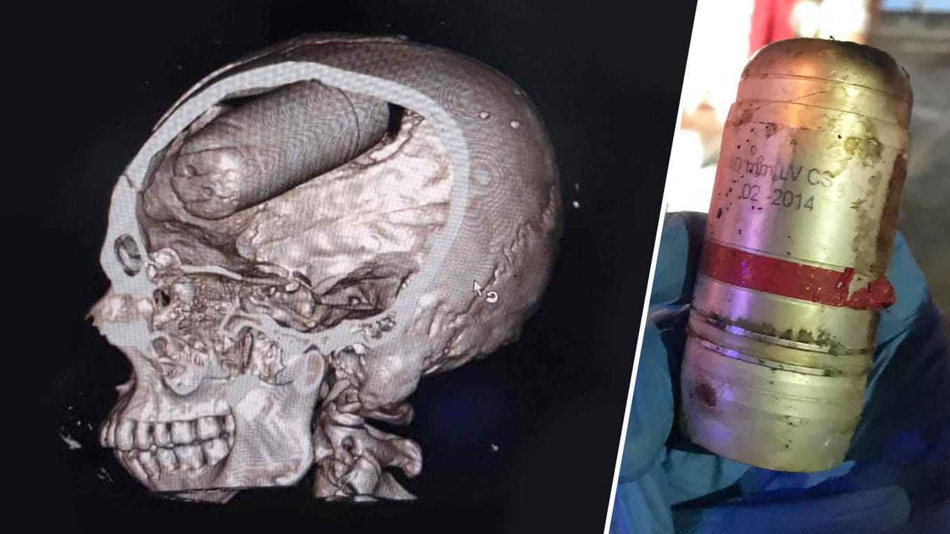 Tief in den Kopf eingedrungen: Der CT-Scan eines Opfers in einem Krankenhaus in Bagdad zeigt, wie verheerend die Granaten wirken. Anstelle von Tränengas setzen die Sicherheitskräfte militärische Rauchgasgranaten ein, die zehnfach so schwer wirken.