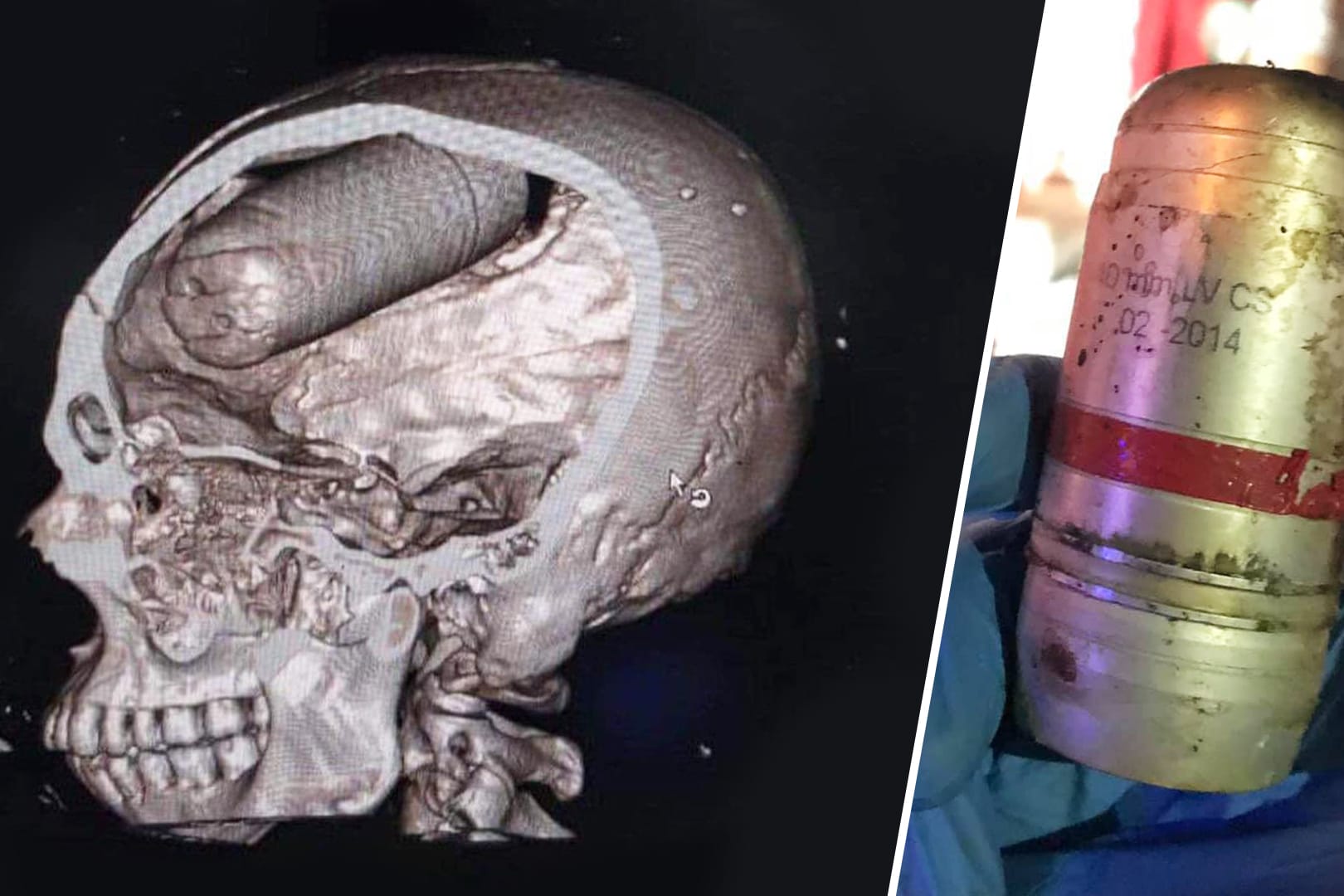 Tief in den Kopf eingedrungen: Der CT-Scan eines Opfers in einem Krankenhaus in Bagdad zeigt, wie verheerend die Granaten wirken. Anstelle von Tränengas setzen die Sicherheitskräfte militärische Rauchgasgranaten ein, die zehnfach so schwer wirken.