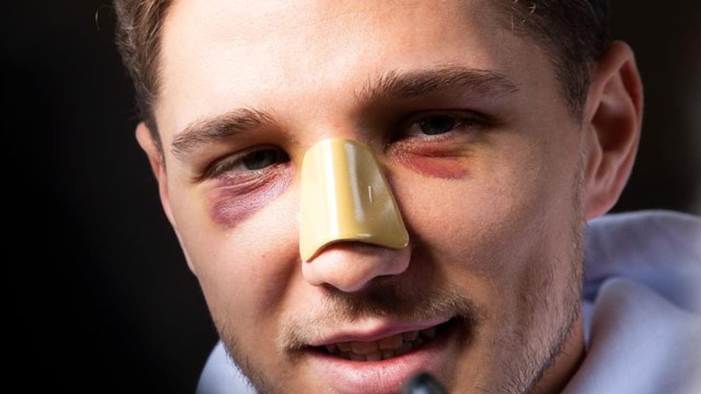 Niklas Stark zog sich in der Bundesliga einen Nasenbeinbruch zu.