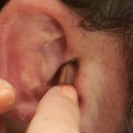 Hörgerät wird ins Ohr eingesetzt: Hängen Demenz und Schwerhörigkeit zusammen, beugt ein Hörgerät dem Gedächtnisverlust vor.