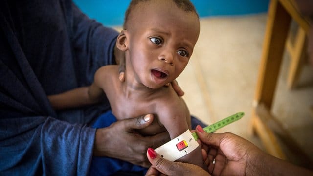 Im Gesundheitszentrum von Gao (Mali) wird der arm eines schwer unterernährten, 16 Monate alten Kindes vermessen. Im Gesundheitszentrum von Gao (Mali) wird der arm eines schwer unterernährten, 16 Monate alten Kindes vermessen.