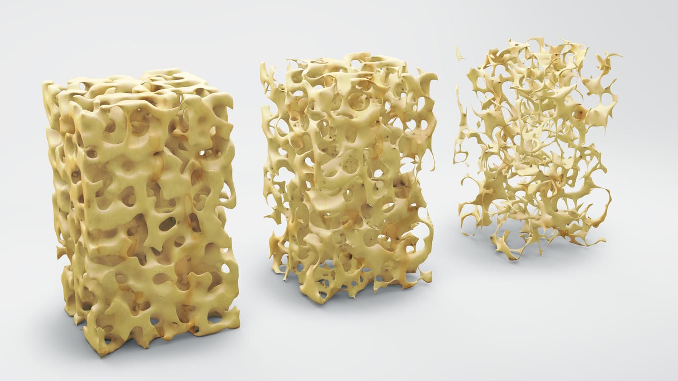 Struktur eines gesunden Knochens (links) und die Auflösung der Knochensubstanz bei Osteoporose (Mitte und rechts)