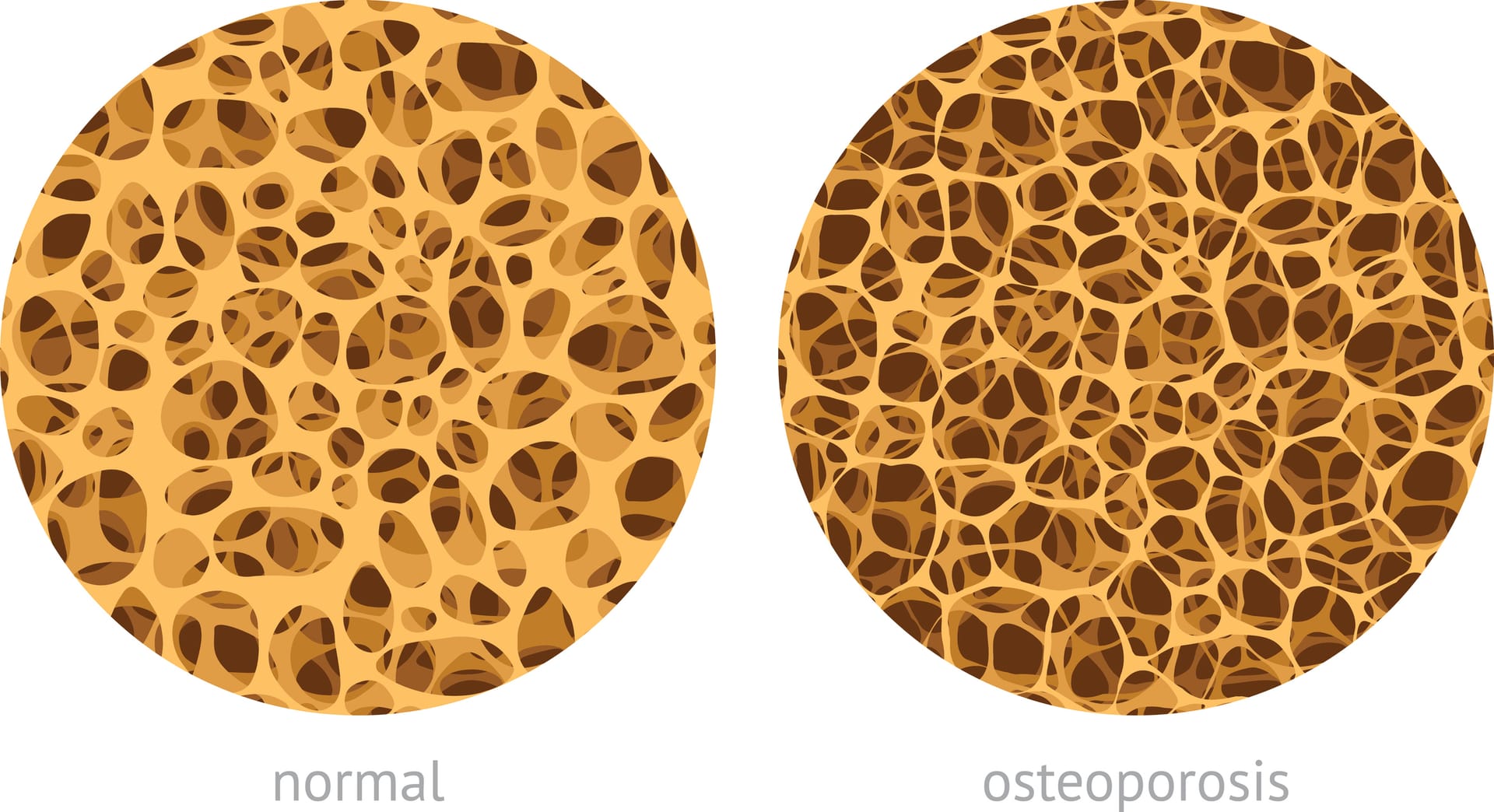 Links: Querschnittillustration eines gesunden Knochens. Rechts: Querschnittillustration eines Knochens mit Osteoporose.