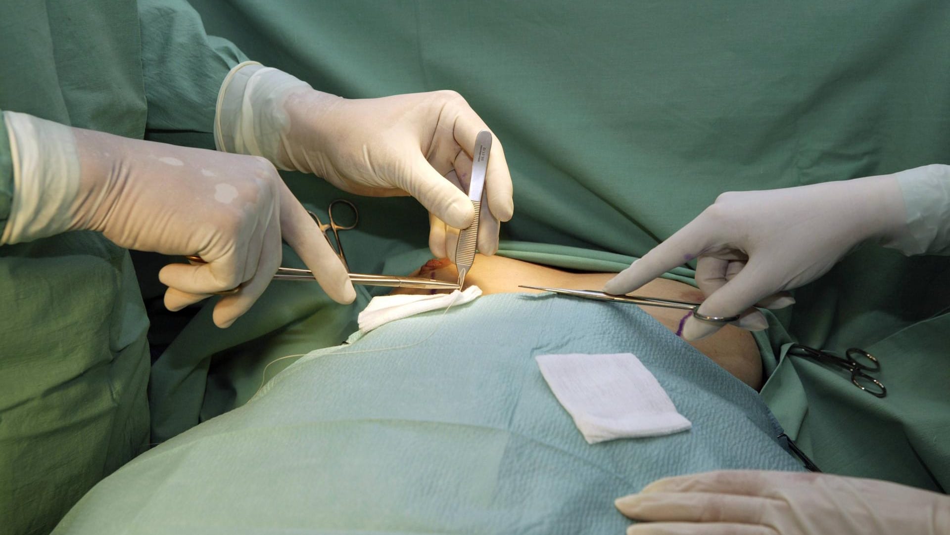 Eine Frau während einer Schönheitsoperation: Die Frau verstarb nach einigen Wochen an Hirnschäden im Krankenhaus. (Symbolbild)