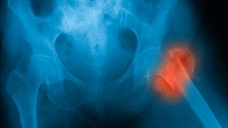 Röntgenaufnahme des Beckens: Osteoporosebedingte Oberschenkelhalsbrüche werden meist durch einen Sturz ausgelöst.
