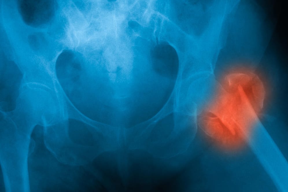 Röntgenaufnahme des Beckens: Osteoporosebedingte Oberschenkelhalsbrüche werden meist durch einen Sturz ausgelöst.