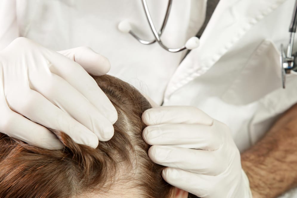Seborrhoisches Ekzem: Der entzündliche Hautauschlag tritt häufig auf der Kopfhaut auf.