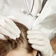 Seborrhoisches Ekzem: Der entzündliche Hautauschlag tritt häufig auf der Kopfhaut auf.