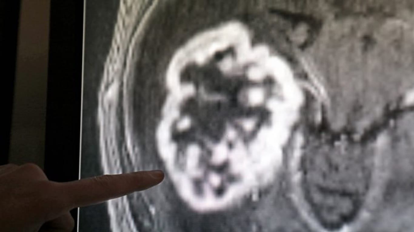 Mit Hilfe der Magnetresonanztomographie wird ein Tumor festgestellt.