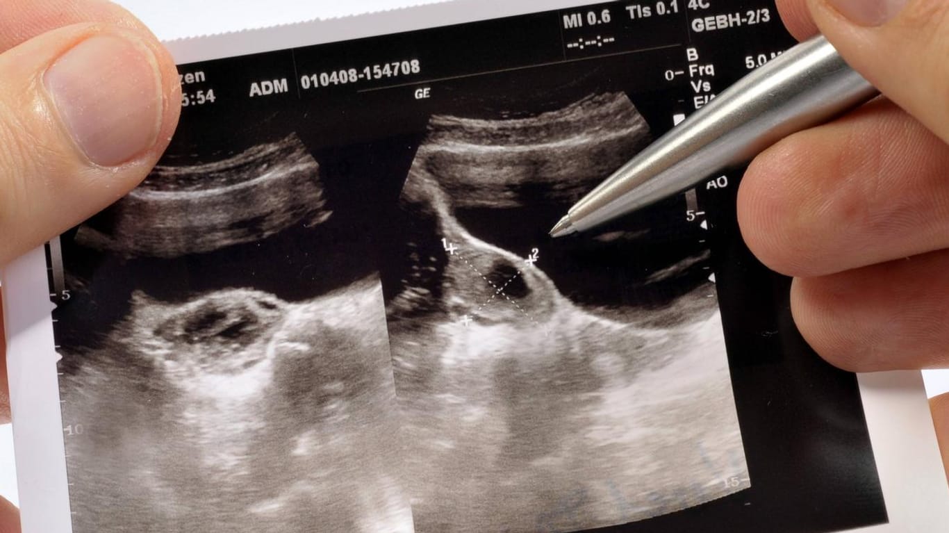 Ultraschallbild: Oft werden Zysten am Eierstock bei einer Routineuntersuchung beim Frauenarzt entdeckt.