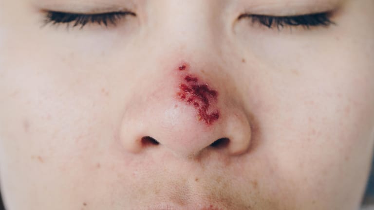 Herpes auf der Nase: Eine Wiedererkrankung mit Windpocken im Erwachsenenalter kann gefährlich werden und sollte daher schnell behandelt werden.