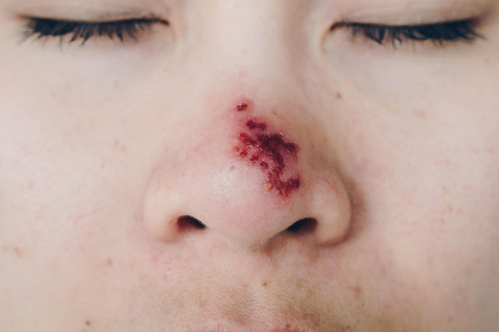 Herpes auf der Nase: Eine Wiedererkrankung mit Windpocken im Erwachsenenalter kann gefährlich werden und sollte daher schnell behandelt werden.