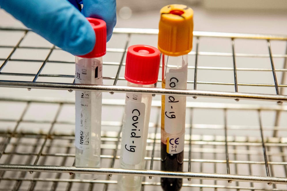 Proben, die auf die Viruserkrankung Covid-19 getestet wurden: In einem Labor im Kreis Ravensburg sind fast 2.000 Proben liegengeblieben, weil die nötigen Chemikalien gefehlt haben. Viele sind nun unbrauchbar. (Symbolfoto)